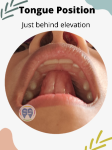  Correct tongue position