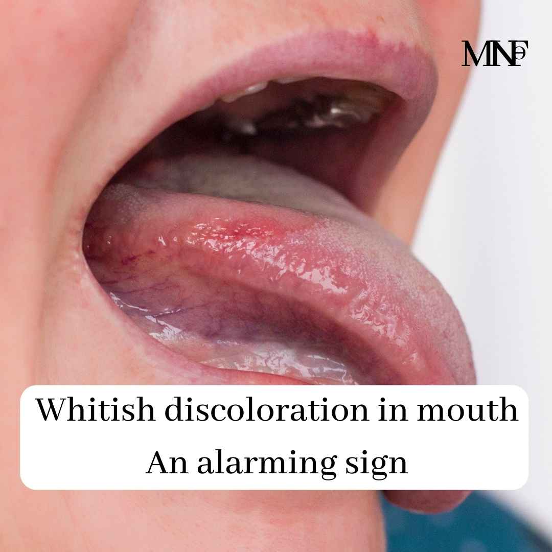 Whitish discoloration in mouth- An alarming sign - Smile Specialists