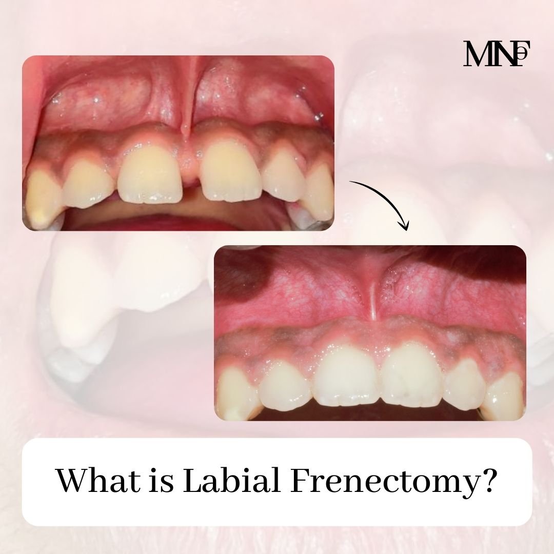 Frectomy Frenectomy With Braces : Labial Frenectomy – ZUCNYS