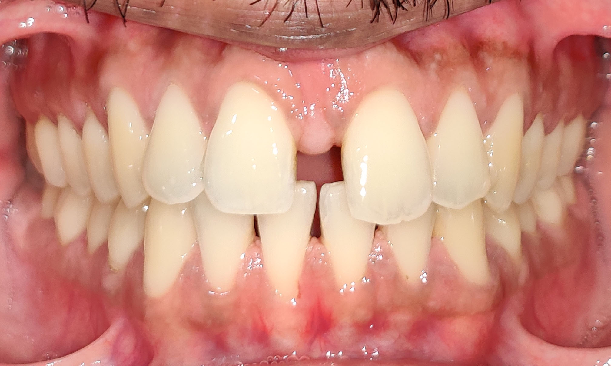 Aligner Treatment of spaces between teeth