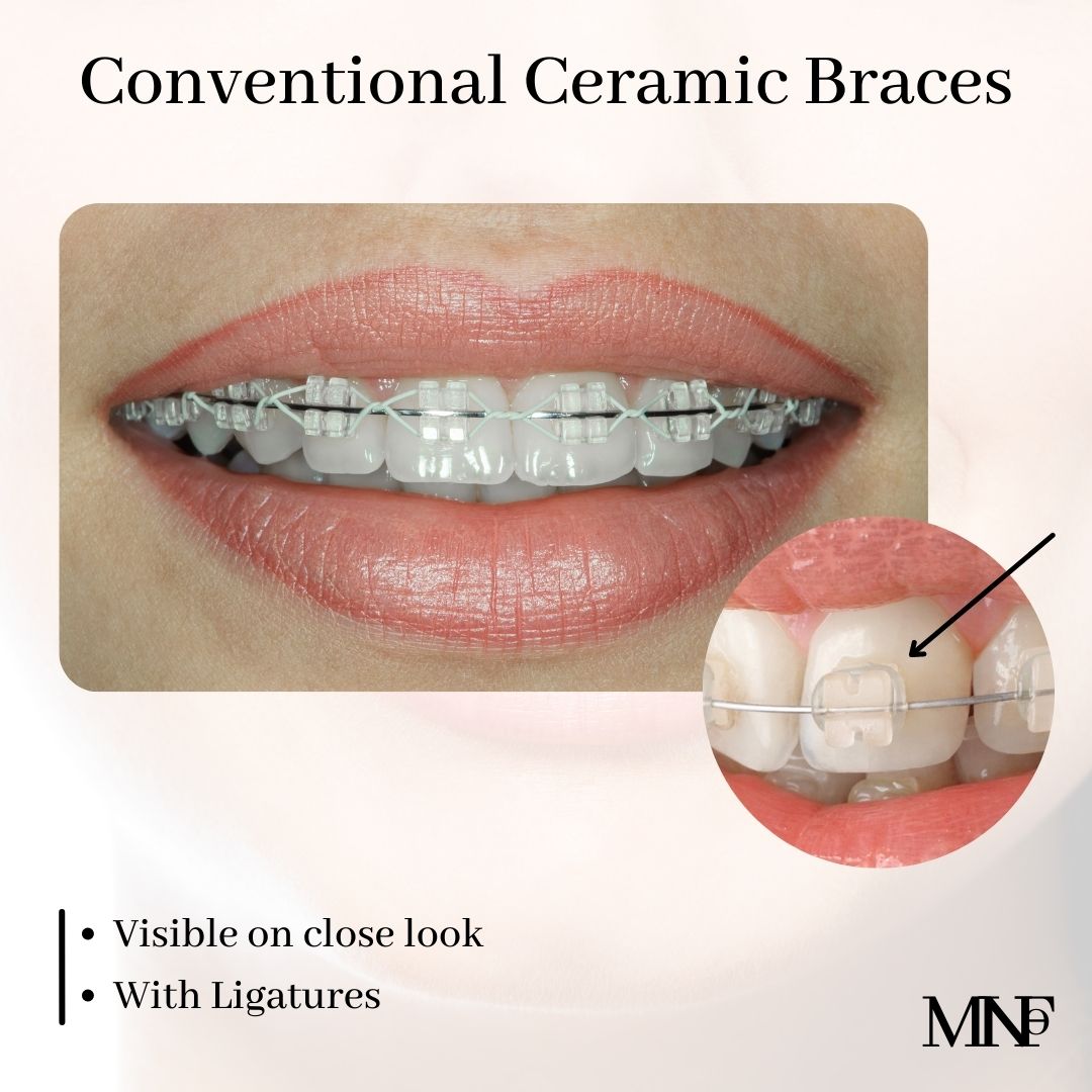Conventional-Ceramic-Brackets