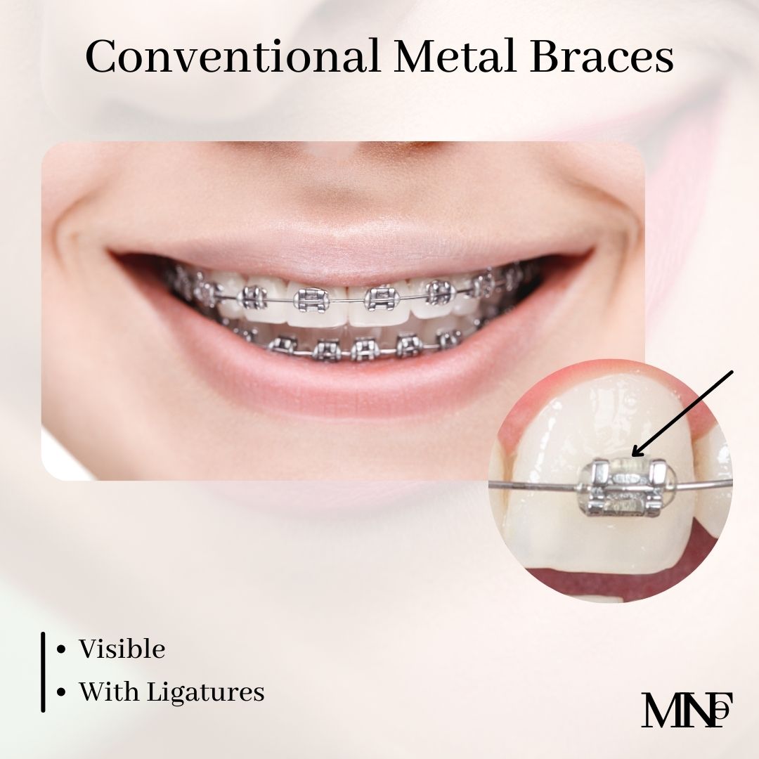 Conventional-Metal-Brackets (1)