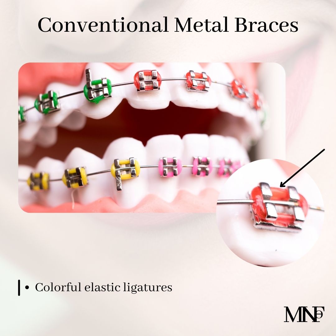 Conventional-Metal-Brackets-2