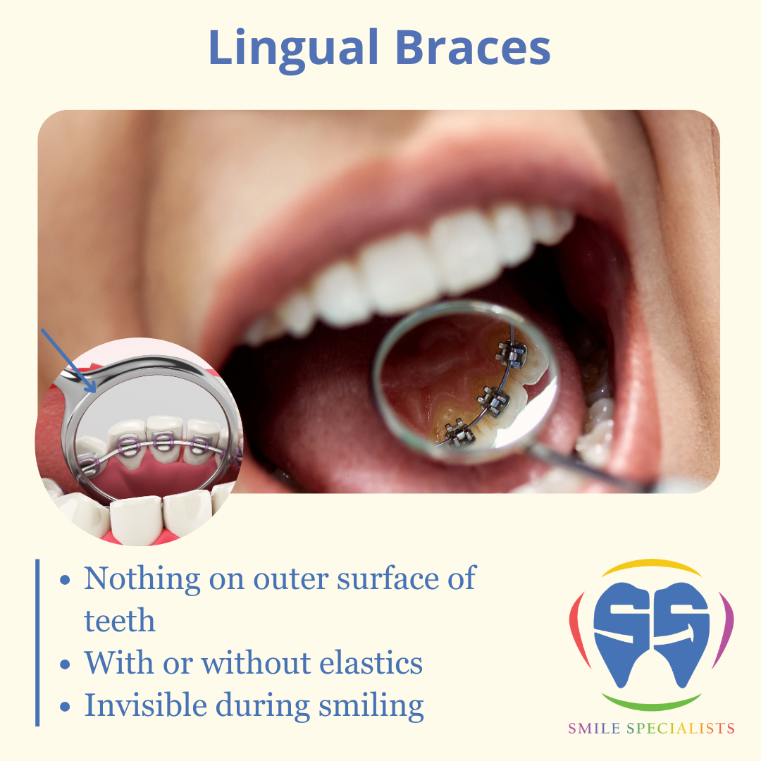 Lingual-Braces