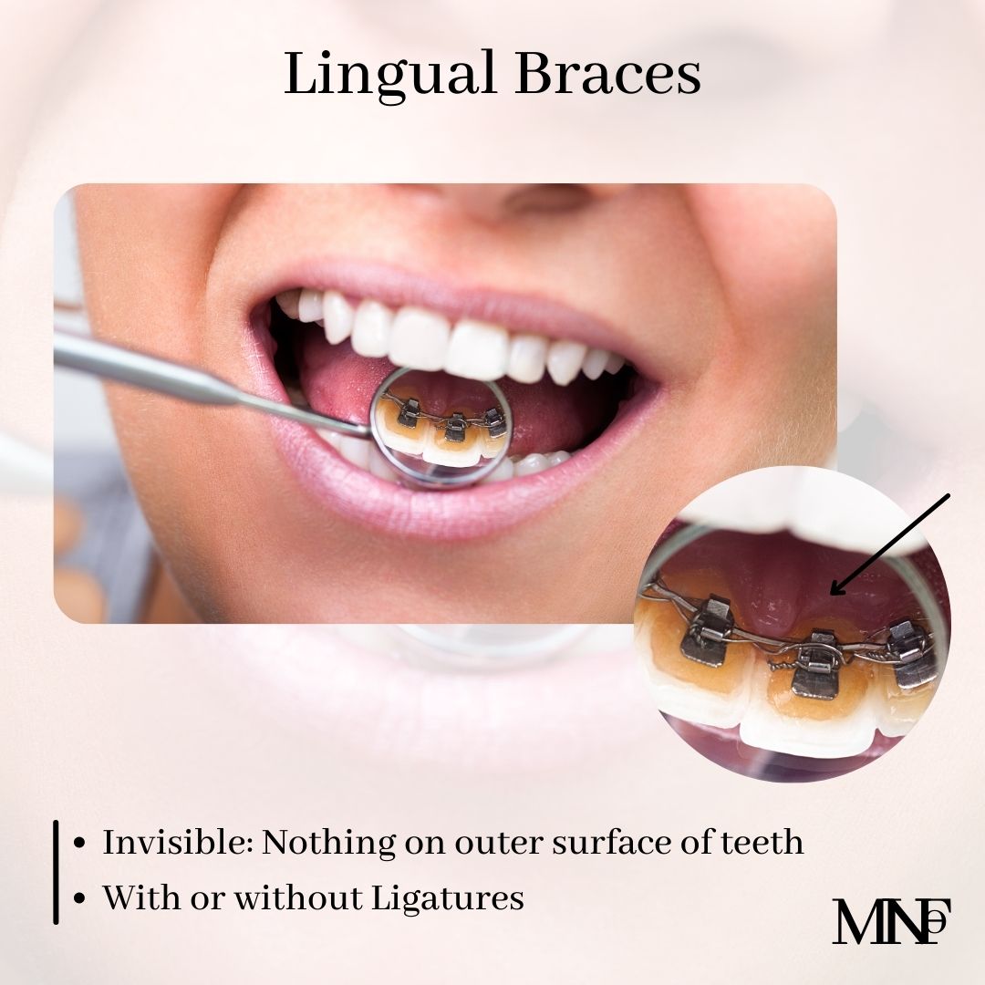 Lingual-Brackets