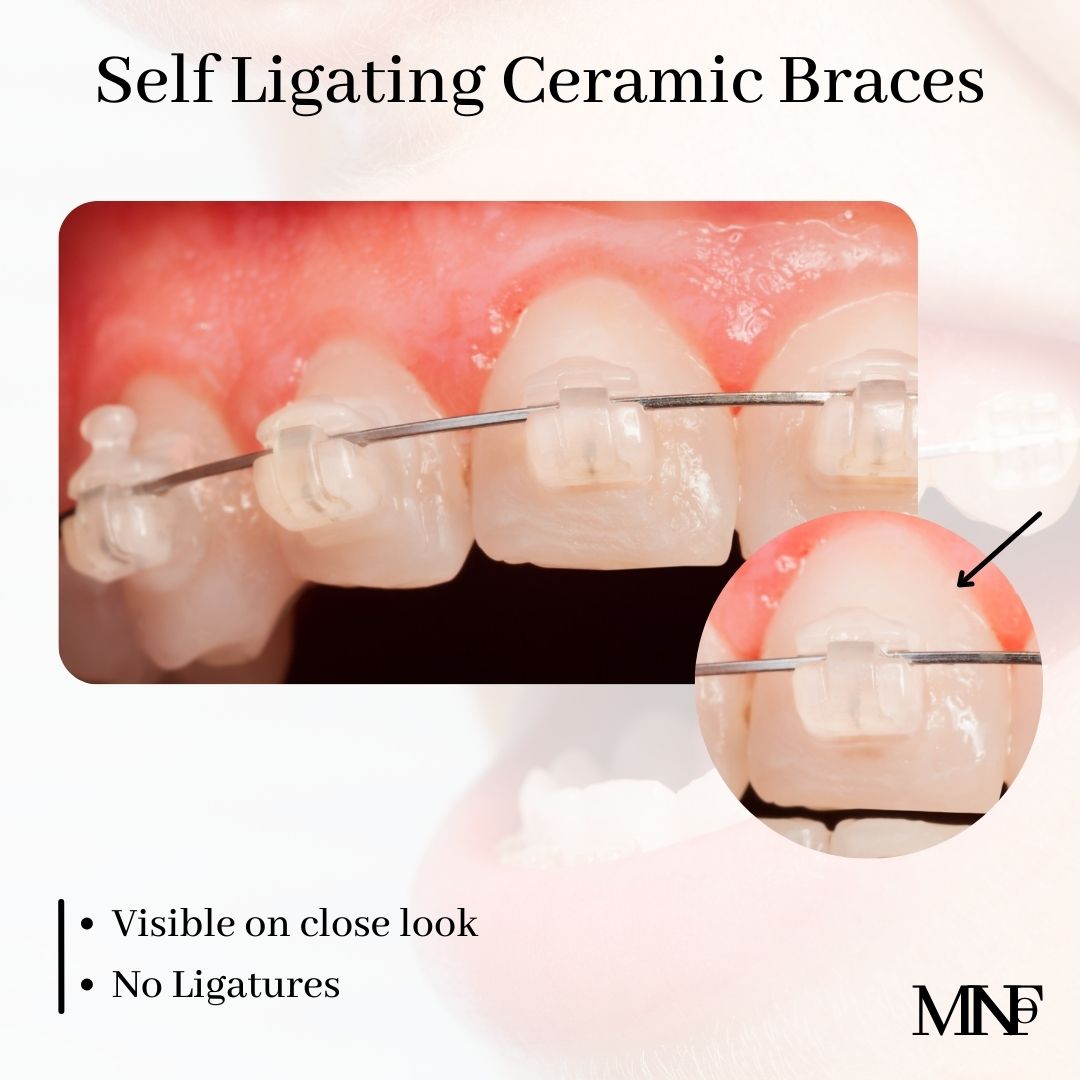 Self-Ligating-Ceramic-Brackets