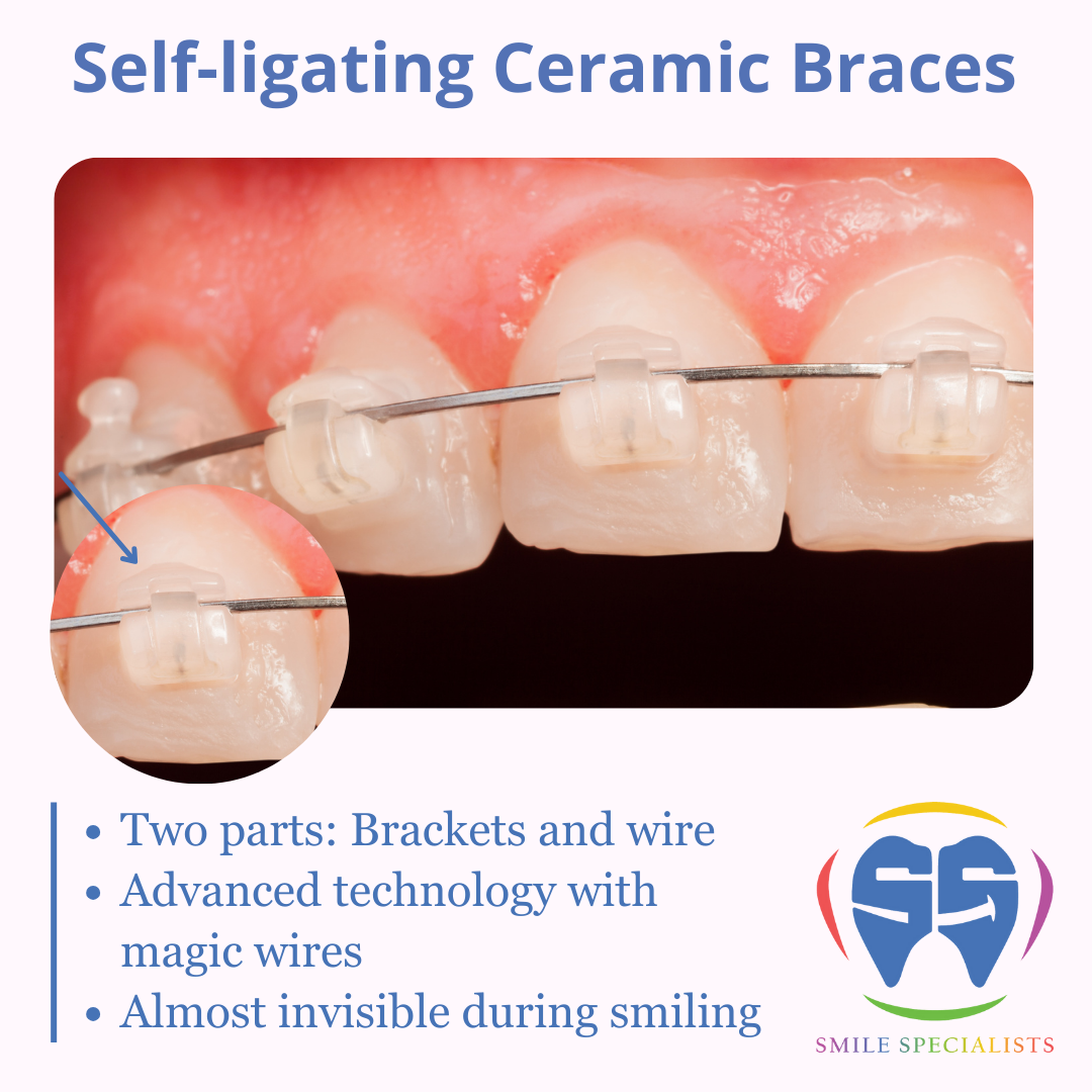 Self-ligating-Ceramic-Braces