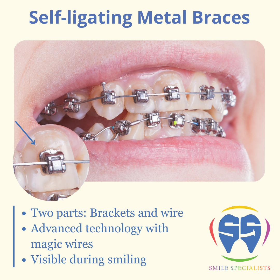 Self-ligating-Metal-Braces