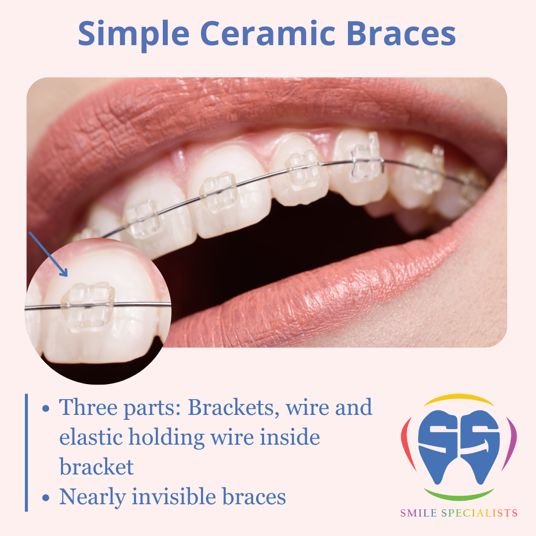 Simple-Ceramic-Braces