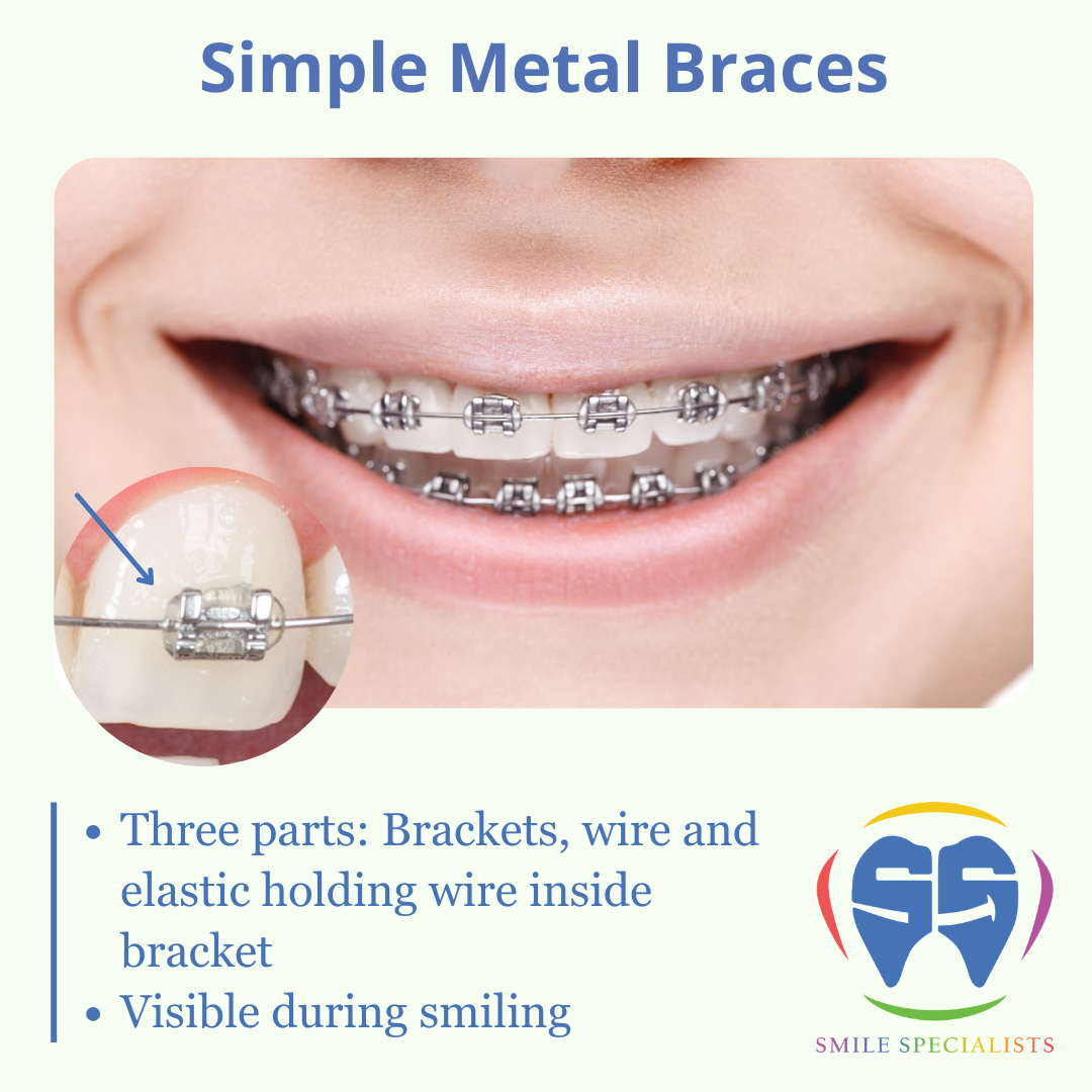 Simple-Metal-Braces